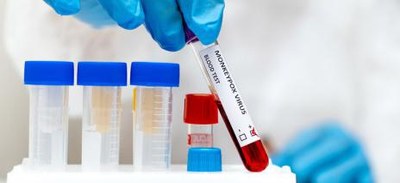 Saúde de Araguaína confirma primeiro caso de monkeypox na cidade