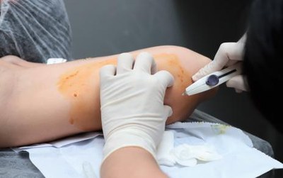 Araguaína é a primeira cidade do Tocantins a ofertar gratuitamente implante hormonal contraceptivo